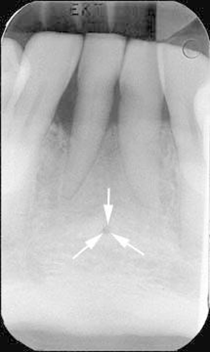 <p>Radiolucent' between apices of mandibular central incisors</p>
