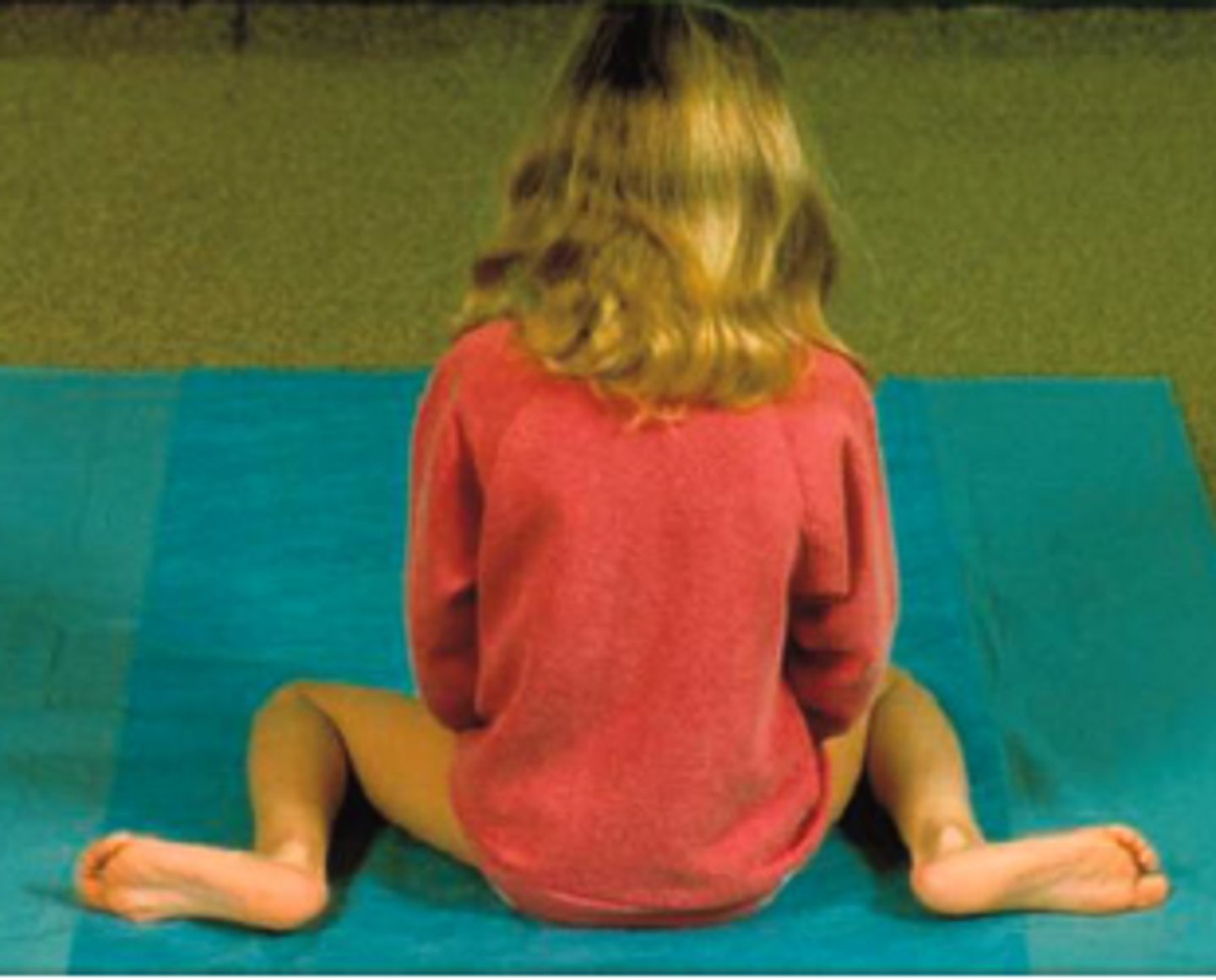 <p>C. Lateral tibial torsion with medial rotation of femur</p>