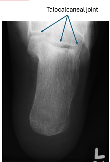 <ul><li><p>entire calc</p></li><li><p>talo-calc joint </p></li></ul><p></p>