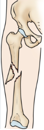 <p>what kind of broken bone is this</p>