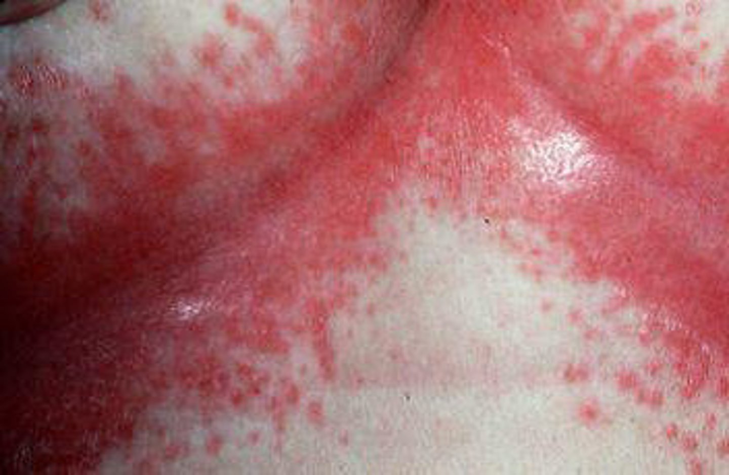 <p>diagnose this image:</p><p>Erythematous, moist, macerated skin folds that may be maledorous</p>