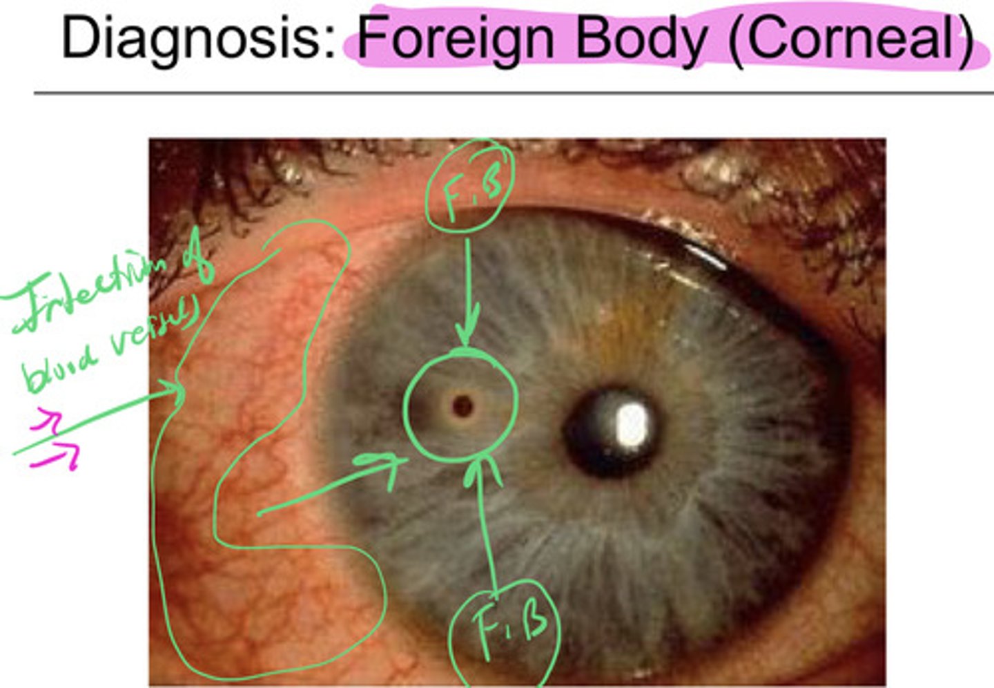 <p>Management includes saline irrigation, topical antibiotics (ointment preferred), pain relief (oral NSAIDs or cycloplegics), and patching the eye for large abrasions (&gt;10 mm) for no more than 24 hours. Ophthalmology follow-up is needed for large abrasions, and oral opioids may be prescribed if necessary.</p>