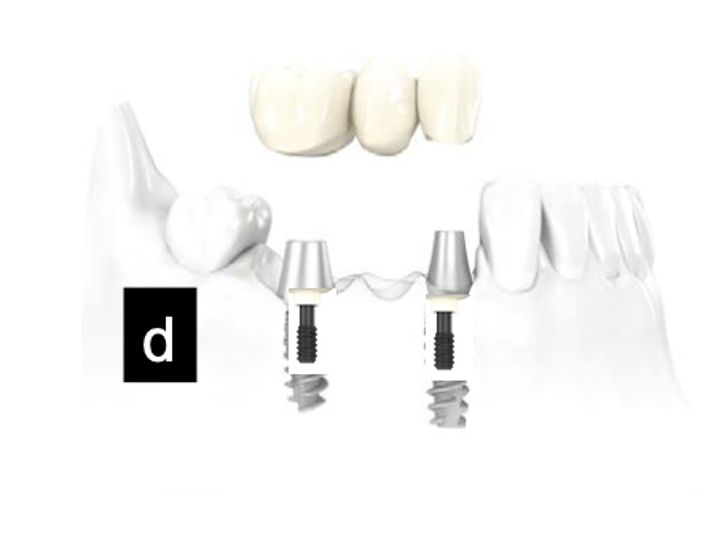 <p>What type of implant does this show?</p>
