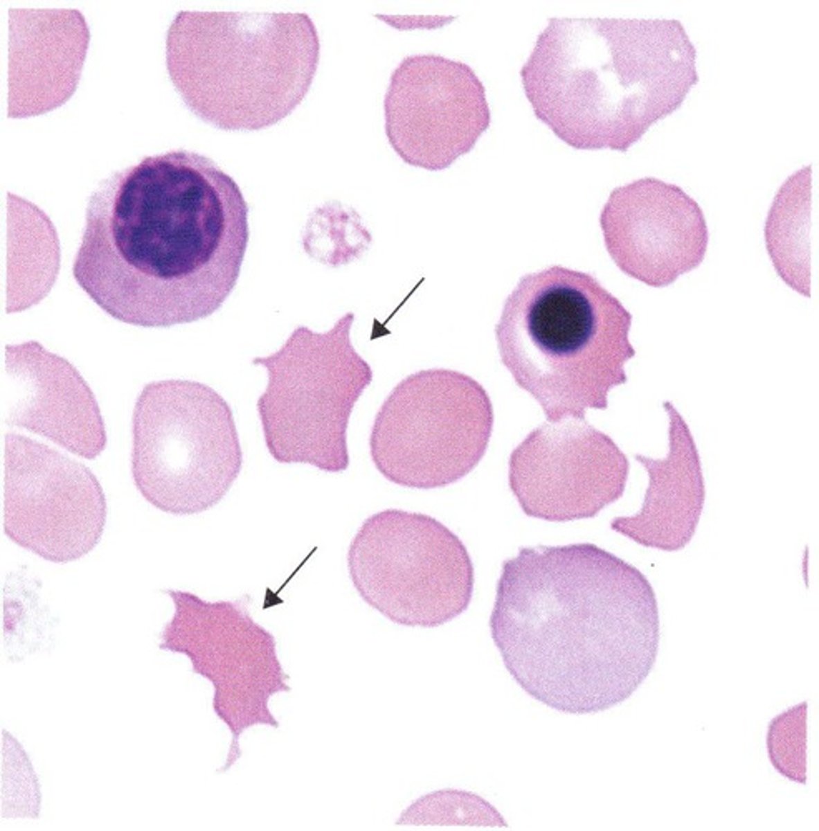<p>Spiculated RBCs with a few unevenly distributed surface projections. These cells are seen in patients with altered lipid metabolism (dogs with hemangiosarcoma, cats with hepatic lipidosis, etc</p>