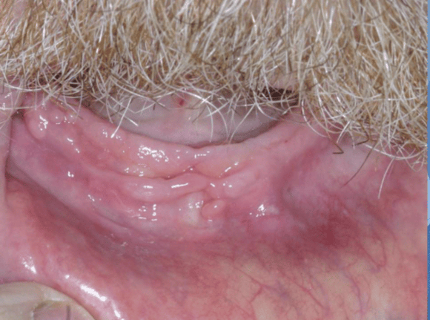 <p>Patient reported that wearing his denture causes pain. What do you suspect?</p>