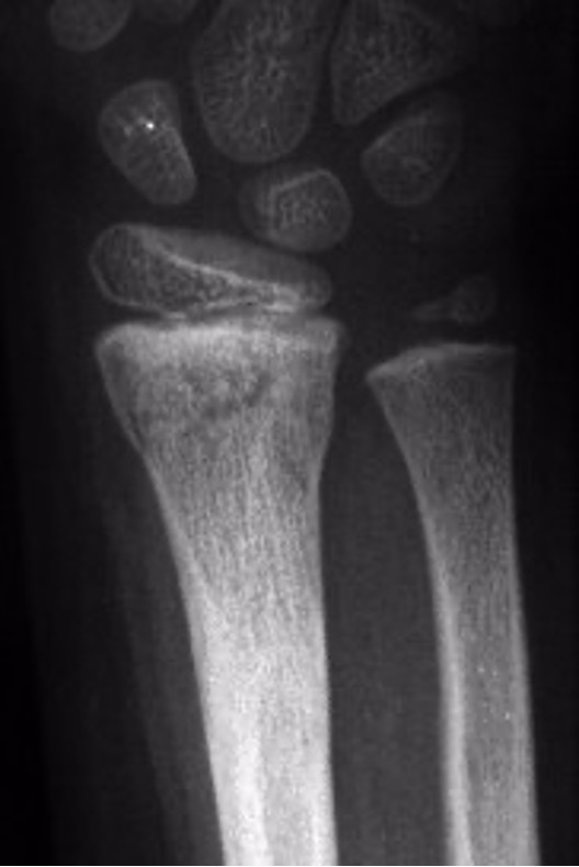 <p>what type of salter Harris fracture is this? what kind of tx is needed?</p>