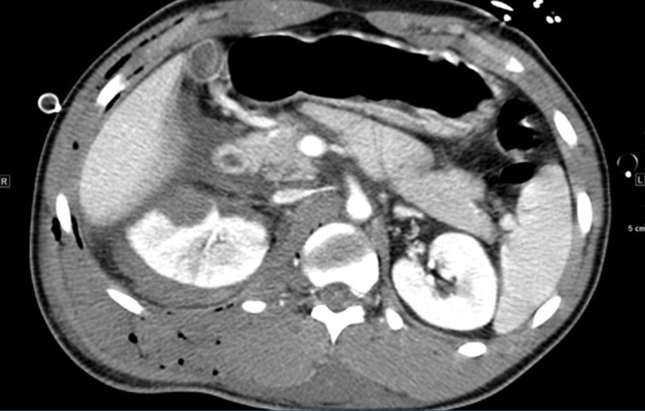 <p>What is CT showing?</p>