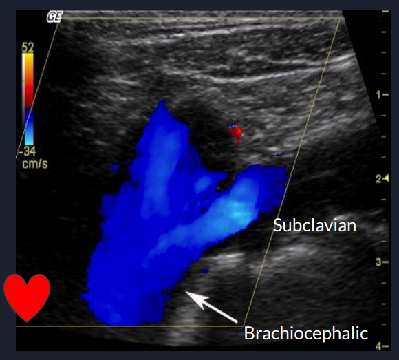<p>describe the blood flow in this image and what is unique about vascular evaluation of the brachiocephalic artery and vein? is this the brachiocephalic artery or vein?</p>