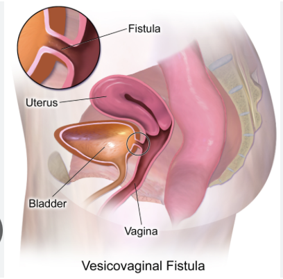 <p><strong><u>Vesicoenteric</u></strong>: 50% due to sigmoid diverticulitis causing pneumaturia, fecaluria (air or stool in urine)</p><p><strong><u>Vesicovaginal</u> (obstetric fistula)</strong>: <strong>secondary to GYN procedure</strong> causing urinary leak through vagina</p>