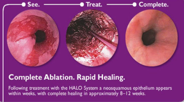 <p><strong>Barrett’s Esophagus: Treatment</strong></p><p>-___ → all patients indefinitely, might prevent cancer</p><p>-Endoscopic __________ therapy (if dysplasia present)</p><ul><li><p>________ therapy</p></li><li><p>Radiofrequency ablation, photodynamic therapy, cryotherapy</p></li><li><p>Resection</p></li></ul><p></p>