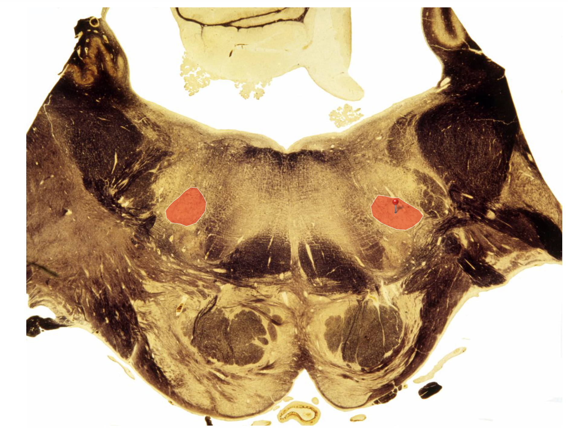 <p><u>Facial Nucleus </u></p><p></p><p><span>Innervates Muscles of Facial Expression &amp; <strong>Stapedius </strong>of Inner Ear</span></p><p></p><p></p>