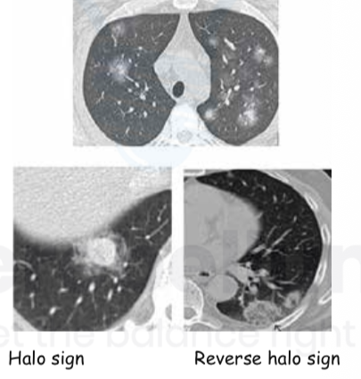 <p>Multiple nodules with central solid part ( ground glass opacity )</p>