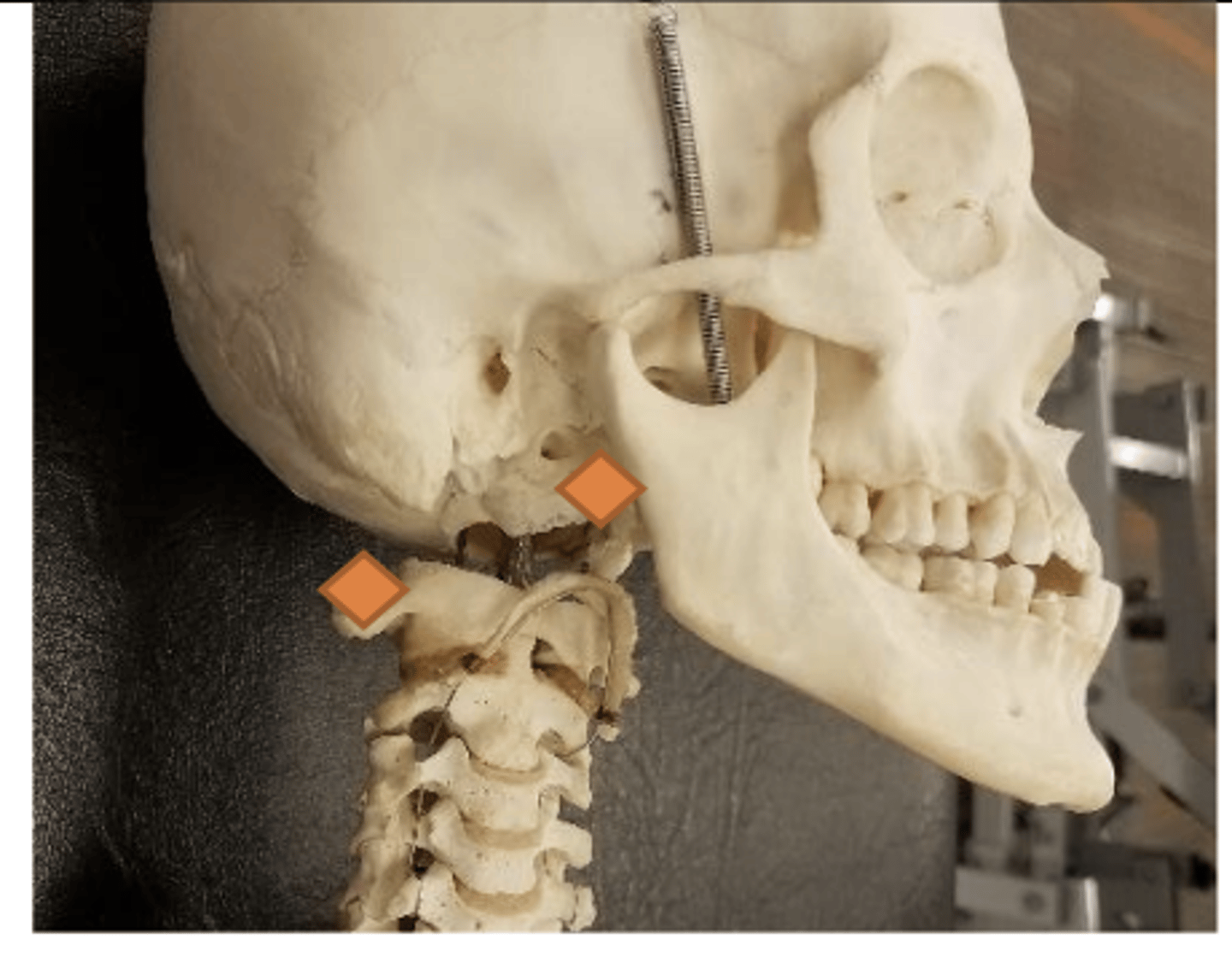 <p>ascending ramus of mandible (AC1 mandible)</p><p>lateral tip of C1 transverse process (AC1 TP)</p>