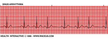 Abnormal heart rhythm