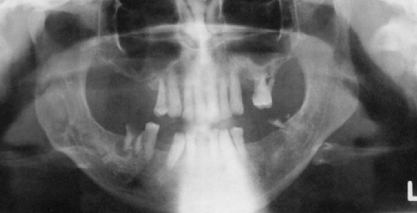 <p>What light needs to be repositioned in order to fix the curve of the smile?</p><p>A) mid-sagittal</p><p>B) Frankfort plane</p><p>C) focal trough</p>