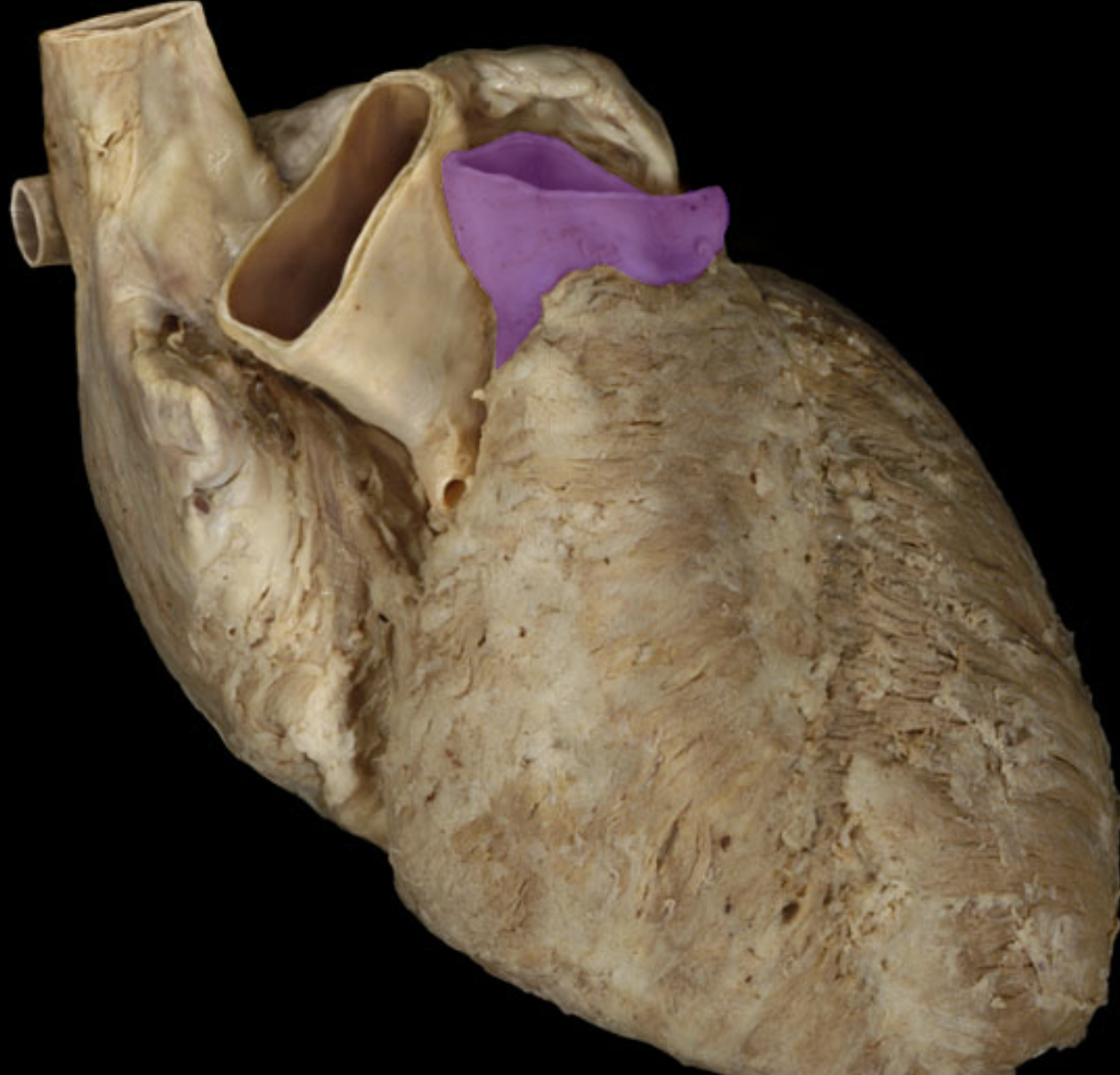 <p>Pulmonary trunk</p>