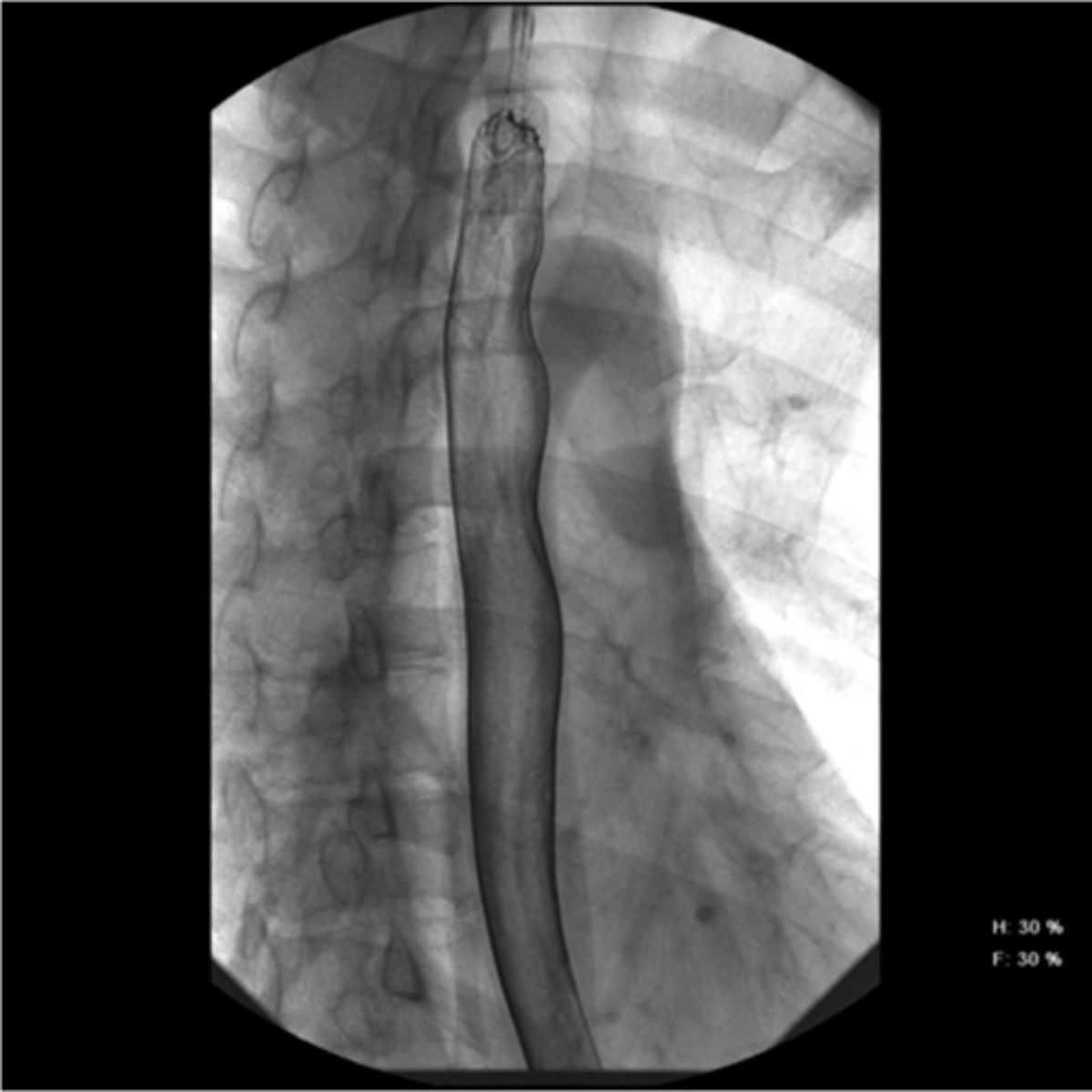 <p>best assessed by upper endoscopy, barium swallow, or gastrofin swallow</p><p>Z line- sometimes visible, junction between mucosa of esophagus and stomach</p>