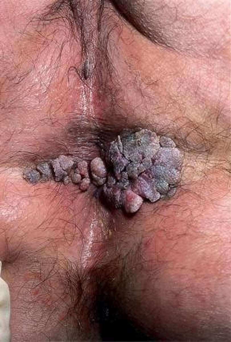 <p>Condyloma</p>