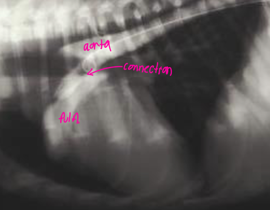 <p>-see the shunt</p><p>-left ventricular dilation</p><p>-opacification of aortic and pulmonary arteries</p>