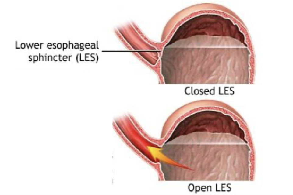 <p>acid from stomach can splash up into lower esophagus….</p><ul><li><p>during respiration (when intrathoracic pressure drops)</p></li><li><p>during churning of stomach</p><ul><li><p>results in gastroesophageal reflux disease (GERD) </p><ul><li><p>produces heartburn</p></li></ul></li></ul></li></ul><p></p>