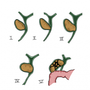 <p>1 sem fístula (apenas compressão do hepático comum) - cvl + colangio intraop (dreno kehr se dúvida)</p><p>2 fístula envolve até 1/3 circunferência do ducto hepático comum - explorar via, sutura fístula, kehr ou coledocoplastia</p><p>3 até 2/3 circunferência do ducto - coledocoplastia</p><p>4 toda a circunferência do ducto - coledocojejunostomia em y de roux</p><p>*5a colecistoentérica sem íleo biliar (coleCINCOentérica com Ausência) - cvl + enterotomia para retirada cálculo</p><p>*5b colecistoentérica com íleo biliar - cvl + enterotomia para retirada cálculo</p><p></p><p>dx cpre intraoperatória</p>
