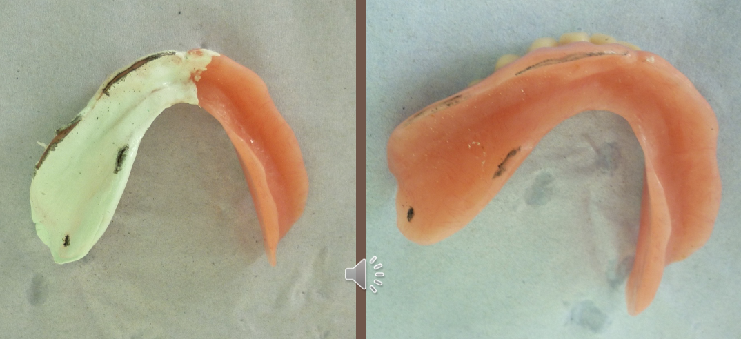 <ul><li><p>marking where the denture shows through the PSI paste</p></li></ul><p></p>