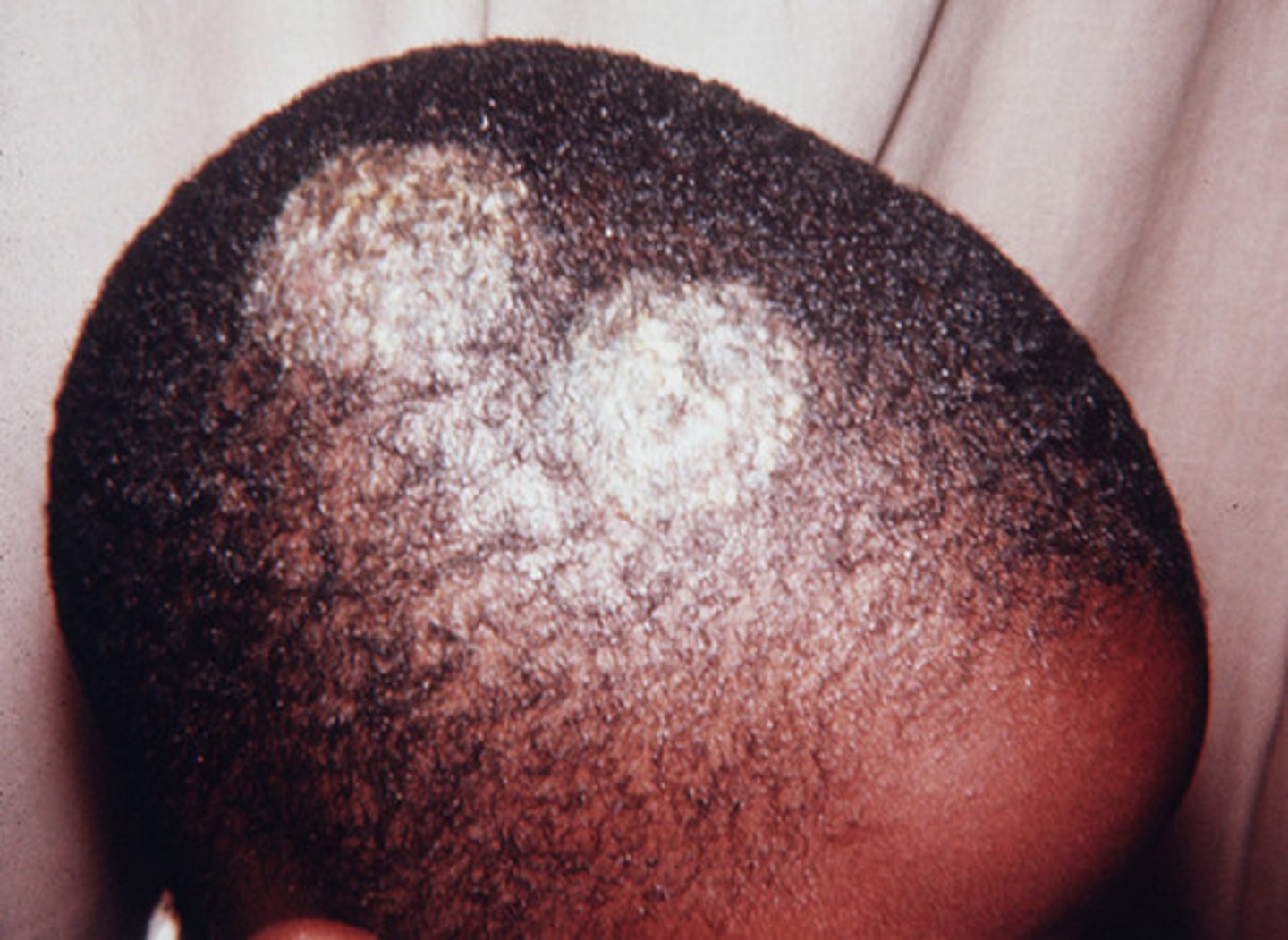 <p>Oral Griseofulvin (Topicals do not penetrate hair shaft adequately)</p>