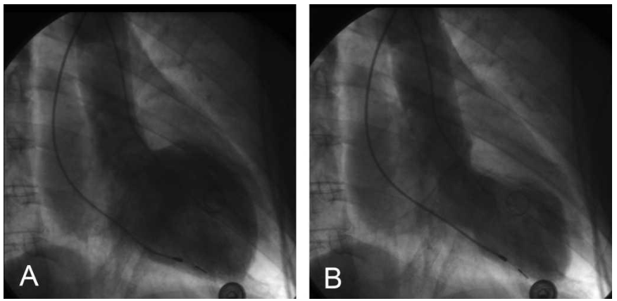 <p>Review the image carefully and give the abnormality seen in the image.&nbsp;<br></p>