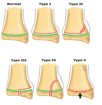 <p>Identifier les 5 types de fractures selon la classification de Salter-Harris</p>