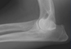 <p>Circle the area of this radiograph that indicates elbow dysplasia. What kind of elbow dysplasia is it?</p>