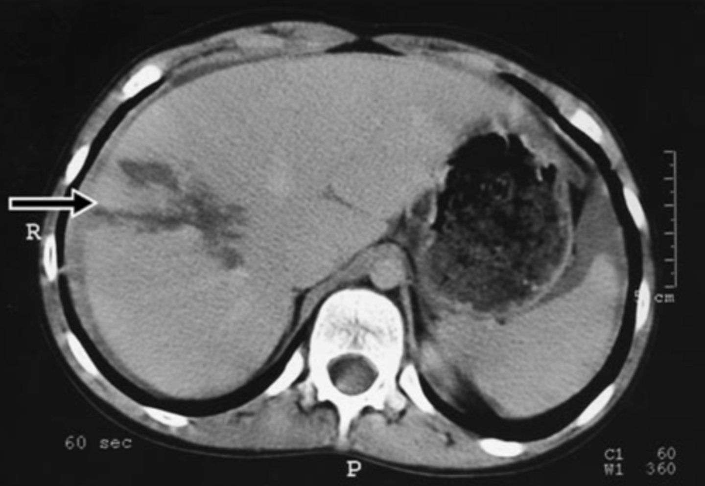 <p>most injured intra-abdominal organ, lacerations and hemorrhages often seen</p>