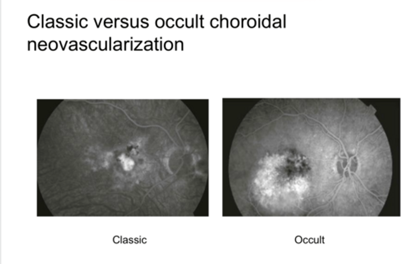<p>What does Classic (Type 1) Choroidal Neovasc Membrane look like on FA?</p>