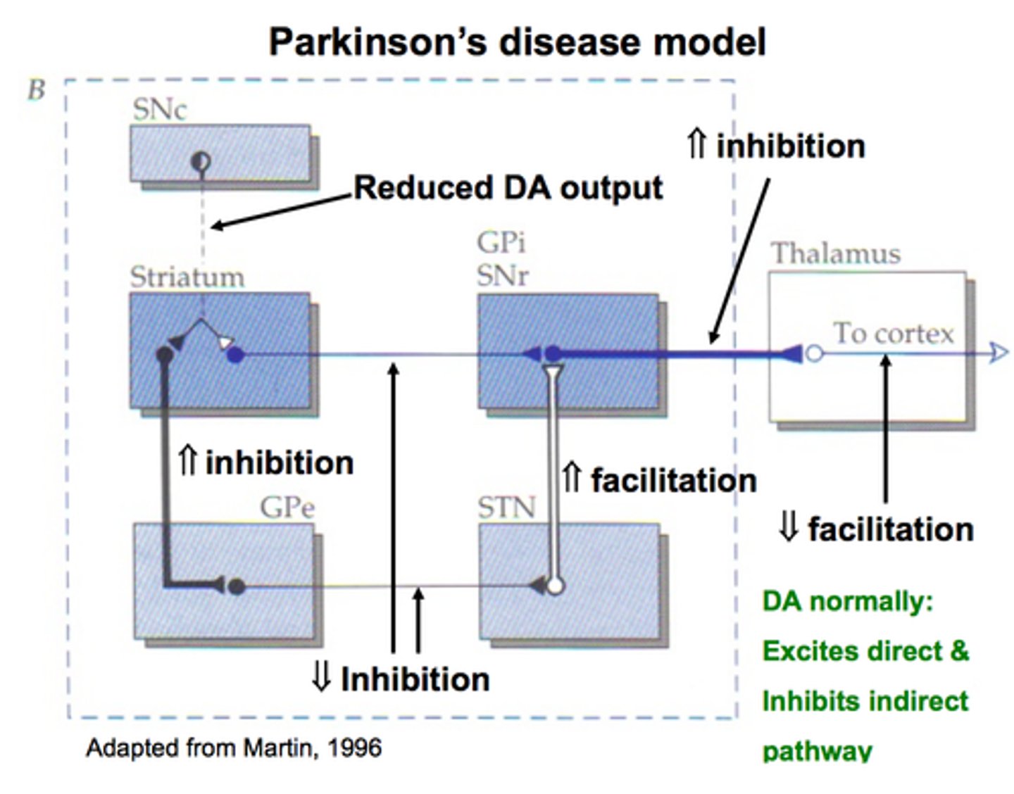 <p>cell death in SN causing loss of dopamine which leads to overactivity in indirect pathway</p>