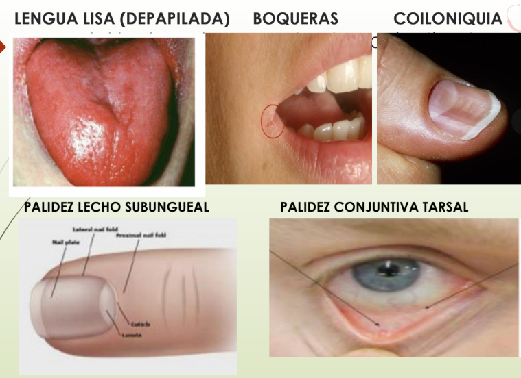 <p>Clinica:</p><p>Mujer joven, 30 años que consulta por fatiga fácil. </p><p>Con historia de <strong>menstruaciones abundantes</strong>.</p><p>Palidez piel y mucosas</p><p>Lengua lisa depapilada, queilosis angular (boqueras)</p>