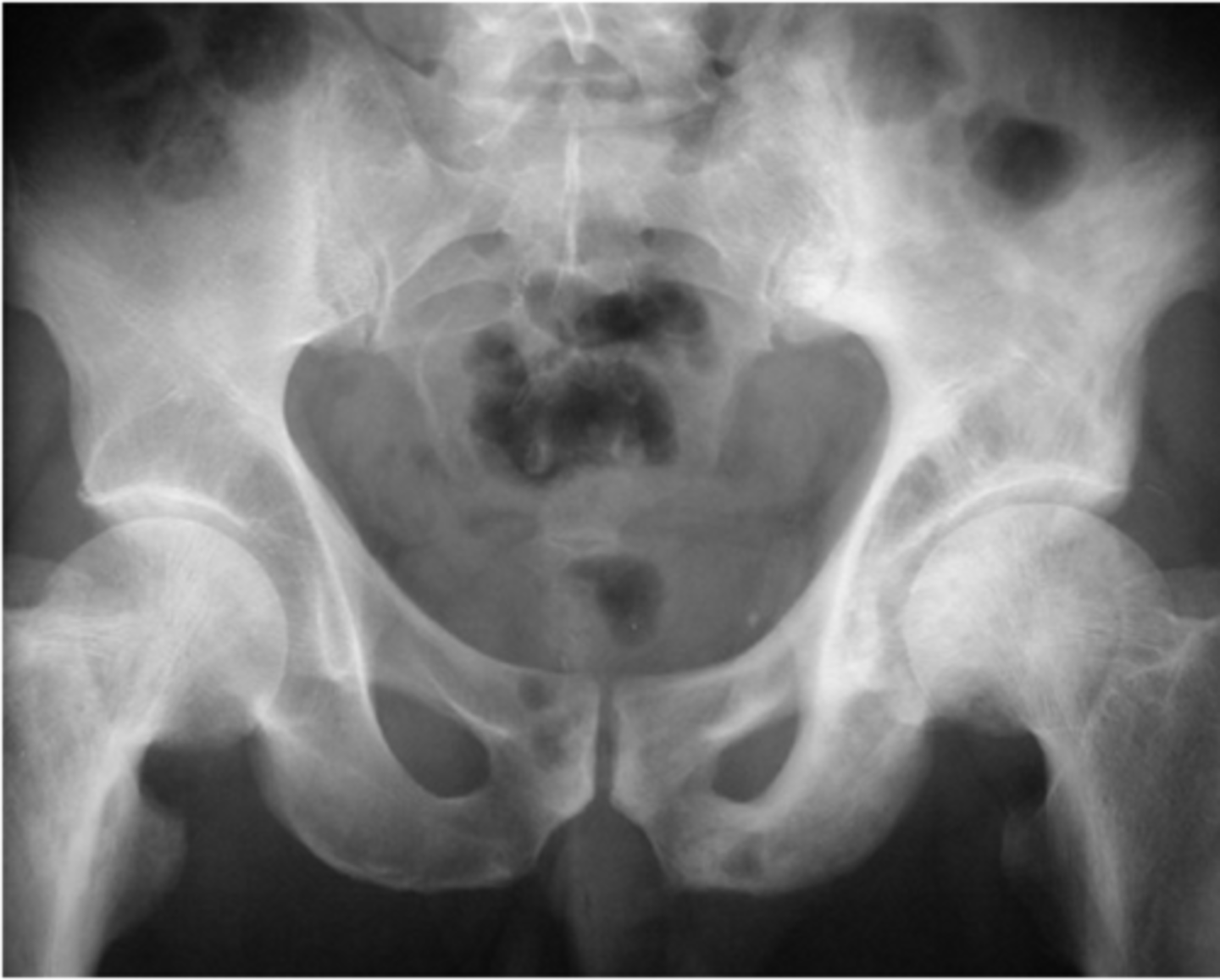 <p><strong>______________</strong> – benign lesion of the pelvis</p><p></p><p>o Increased sclerosis and enlargement of the left hemi-pelvis and right hip</p>
