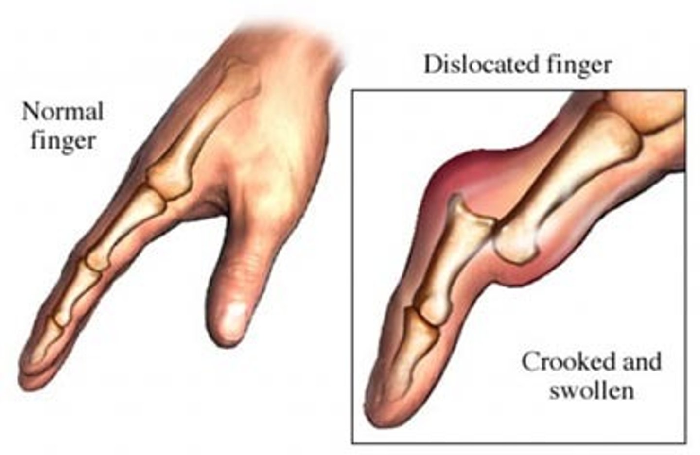 <p>Displacement of a bone from its normal position at a joint, usually accompanied by a sprain of the adjoining connective tissues.</p>