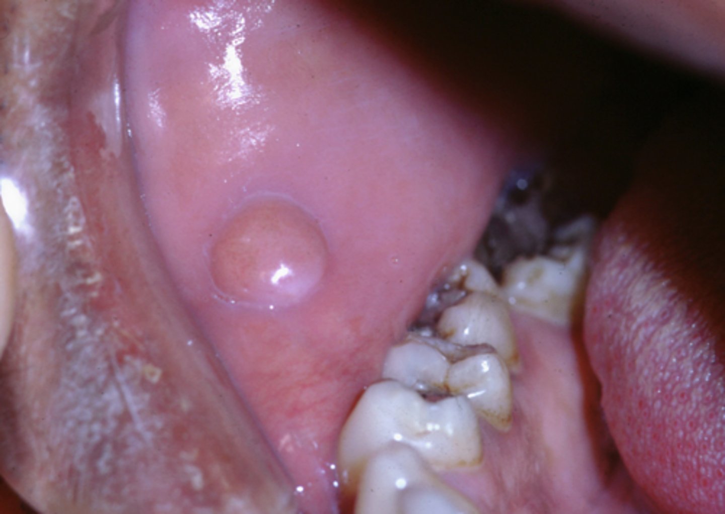 <p>hyperplasia in response to low-grade biting</p><p>it's connective tissue is composed of excessive collagen </p>