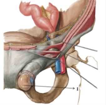 <p>Chi tiết số 1 là:</p><p>A. Túi thoát vị bẹn gián tiếp</p><p>B. Túi thoát vị bẹn trực tiếp</p><p>C. Túi thoát vị đùi</p><p>D. Túi thoát vị bịt</p>