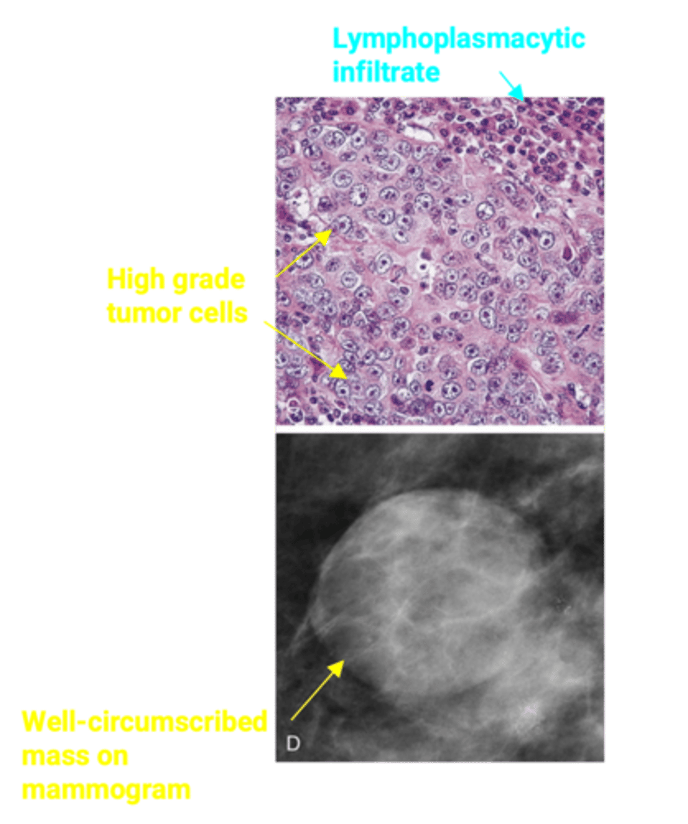 <p>Define Type of Breast Cancer:</p><p>Well-circumscribed mass that can mimic fibroadenoma on mammography</p><p>-Path:</p><p>&gt; Triple negative for ER, PR, and HER2</p><p>&gt; Increased incidence in BRCA1 carriers</p><p>-Dx: Histo:</p><p>&gt; Large, high-grade tumor cells growing in sheets with associated lymphocytes and plasma cells</p><p>-Prog: GOOD!</p>