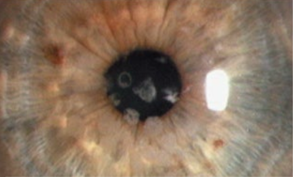 <ul><li><p><span><strong>Symptoms</strong>:</span></p><ul><li><p>asymptomatic early on</p></li><li><p><span>Eventually develop blurred vision, photophobia, glare and pain with RCE</span></p></li></ul></li><li><p><span><strong>Presentation</strong>: small well defined hyaline deposits (crumb like) in the <em>anterior</em> stroma</span></p><ul><li><p><span>There will be a clear space in between the deposits; deposits become more confluent w/ progression</span></p></li><li><p><span>Opacities will extend posterior as the disease progresses</span></p></li><li><p><span>Reduction in corneal sensitivity</span></p></li></ul></li><li><p><span><strong>Complications</strong>: recurrent corneal erosions</span></p></li><li><p><span><strong>Treatment</strong>:</span></p><ul><li><p>observation</p></li><li><p><span>Phototherapeutic keratectomy or lamellar keratoplasty</span></p><ul><li><p>When VA significantly dec</p></li></ul></li></ul></li></ul><p></p>