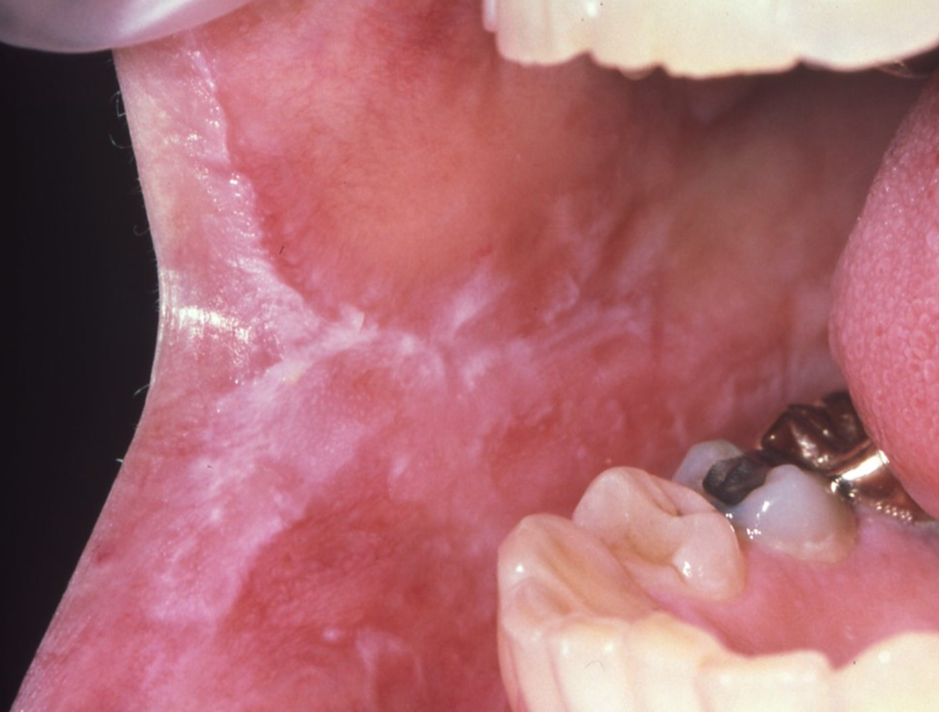 <p>Case 2. A 33-year-old woman reports burning and irritation on the right buccal mucosa with white reticular striations with erythema. 2a. Which of the following is NOT in the differential?</p><p><span>Drug induced lichenoid mucositis</span></p><p><span>Oral lichen planus </span></p><p><span>Cinnamon hypersensitivity</span></p><p><span>Leukoedema</span></p>