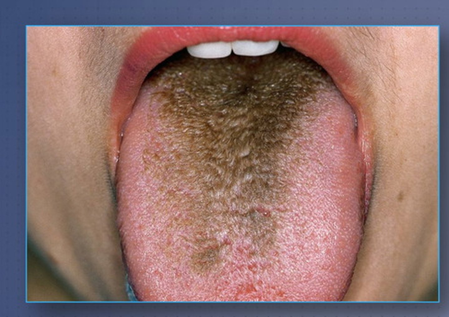 <p>Marked accumulation of keratin</p><p>on the filiform papillae of the</p><p>dorsal tongue, resulting in a</p><p>hair-like appearance</p><p></p><p>Not from fungal infection </p>