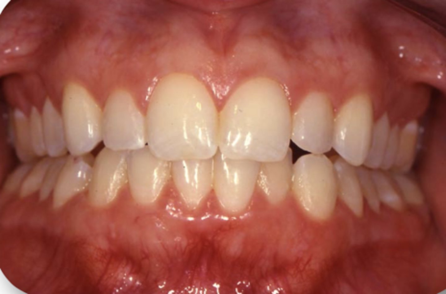 <p>In a full, healthy dentition, there is about ___square centimeters of <strong>pericemental/periodontal support</strong> per arch</p>