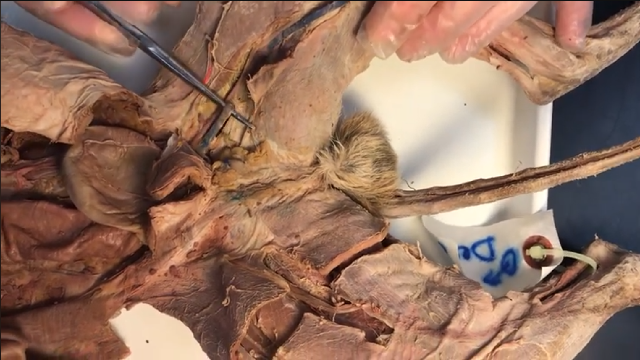 <p>What vein is this</p>