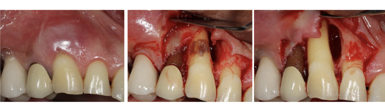 <p>Subgingival calculus </p>
