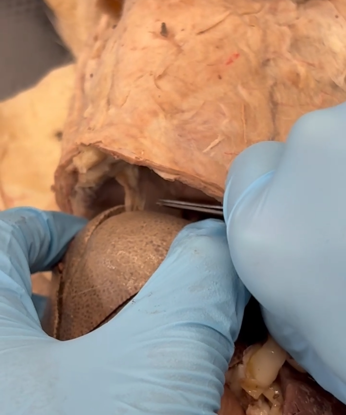 <p>Clear ligament? (answer format: X ligament of Y)</p>