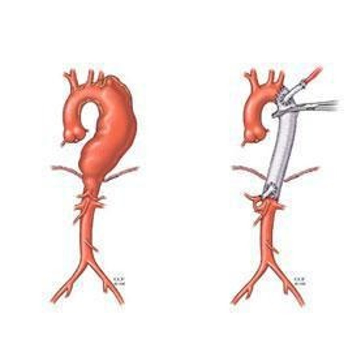 <p>To prevent complications such as aortic rupture, which can lead to sudden cardiac death.</p>