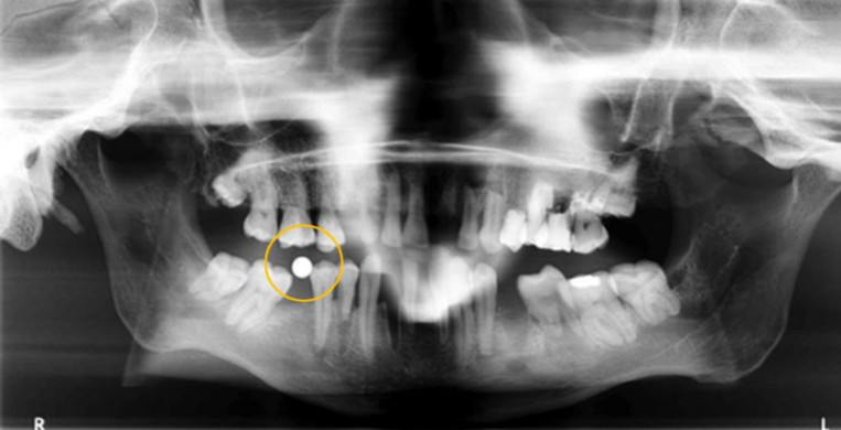 <p>what zone is this in of the focal trough? is it real or a ghost image or a double image </p>