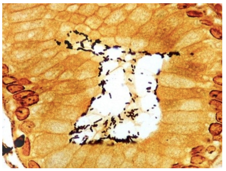 <p>A 40-year-old woman presented with persistent epigastric pain of several months. She reported three episodes of vomiting without diarrhea. The physical examination showed no pathological findings other than a mild tenderness in the upper left abdomen. Upper endoscopy revealed an erythematous antral mucosa. The microscopic appearance of a gastric biopsy specimen stained with Warthin-Starry is shown in the attached figure. Which of the following is the most likely diagnosis?</p><p></p><p>Chronic <em>H. pylori</em> gastritis</p><p></p><p>Autoimmune gastritis</p><p>&nbsp;</p><p>Reactive gastropathy</p><p>&nbsp;</p><p>Stress gastropathy</p><p>&nbsp;</p><p>Ménétrier disease</p>