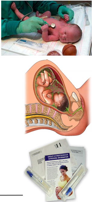 <p><strong>Respiratory distress</strong> occurring at birth to 7 days, with high mortality.</p>